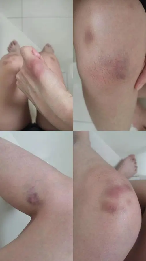 Korban aksi penculikan dan pemerasan alami luka-luka lebam karena diseret dan disekap pelaku. (Foto: X/antum_bit)