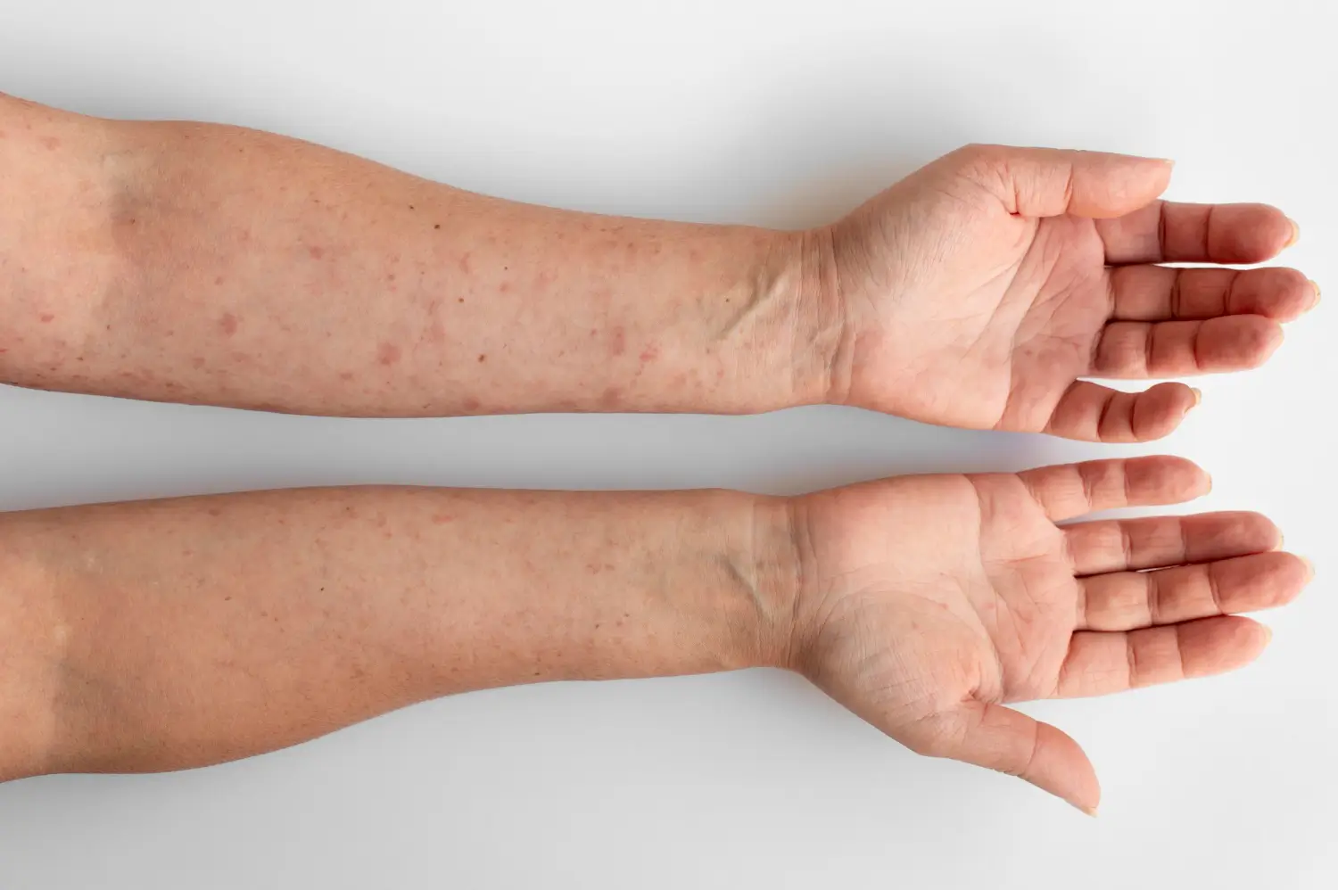 Foto: Ilustrasi Cacar Monyet atau Mpox (freepik.com)